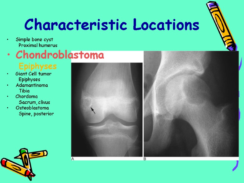 Characteristic Locations Simple bone cyst Proximal humerus Chondroblastoma Epiphyses Giant Cell tumor Epiphyses Adamantinoma